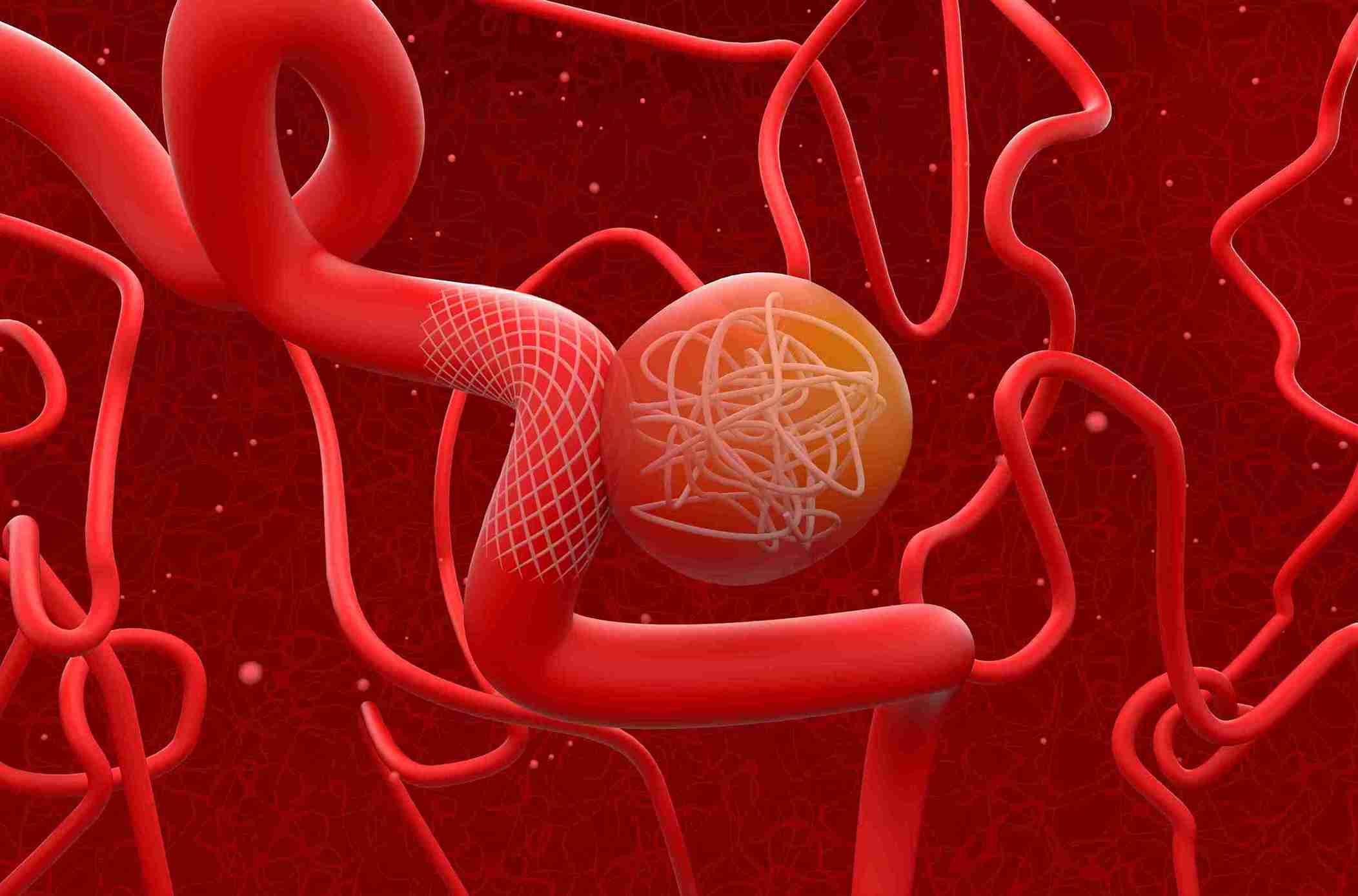 Coiling Aneurisma