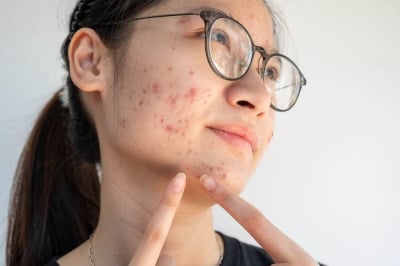 Cara menghilangkan bekas jerawat di pipi