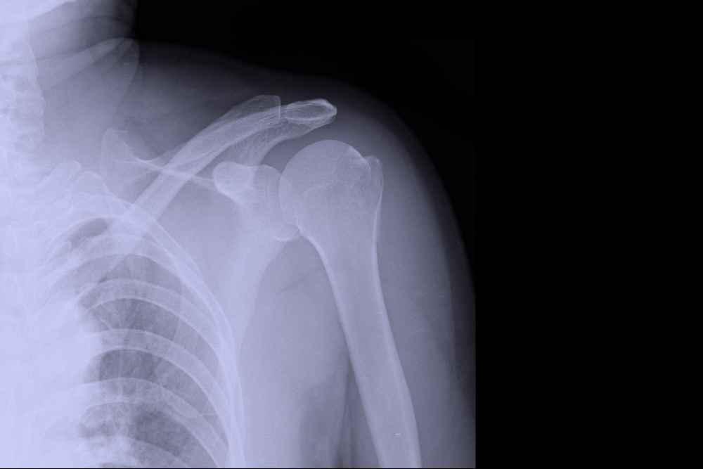 Ketahui Fungsi Sendi Peluru dan Penyakit yang Bisa Terjadi