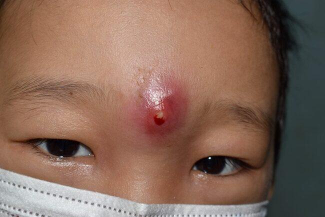 Ketahui Penyebab Bisul pada Anak dan Cara Mengatasinya