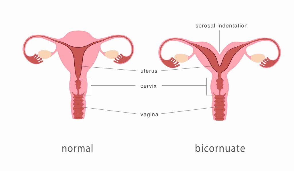 gambar bicornuate uterus