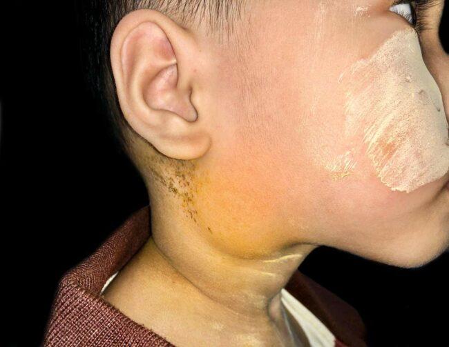 10 Gejala Kanker Limfoma pada Anak Plus Pengobatannya