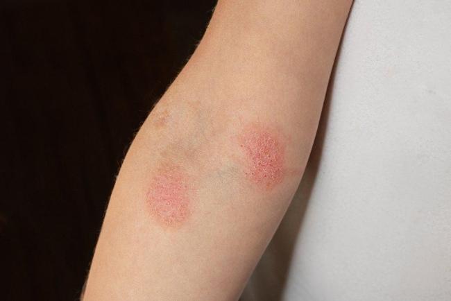 8 Pilihan Obat untuk Bantu Atasi Jamur Kulit secara Alami