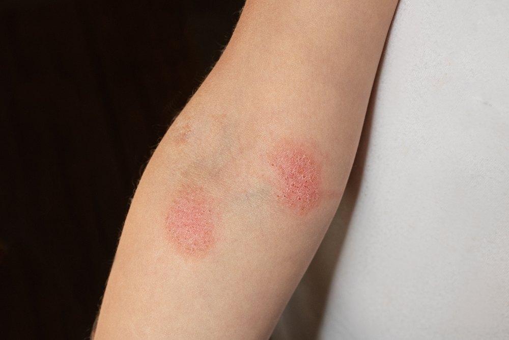 8 Pilihan Obat untuk Bantu Atasi Jamur Kulit secara Alami