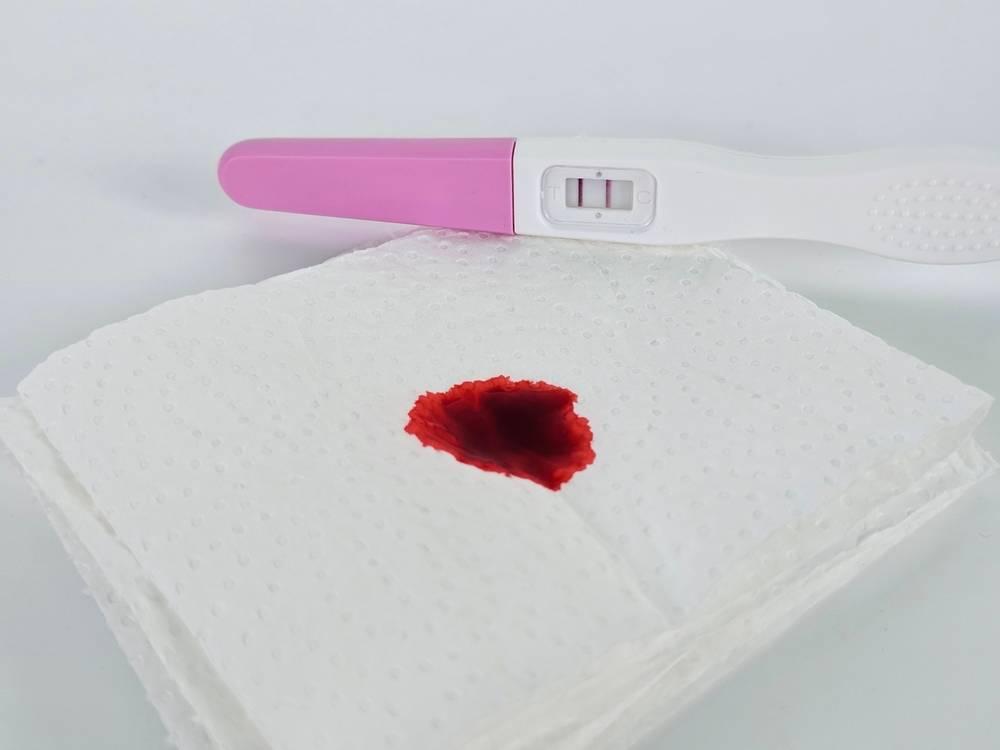 Normalkah Keluar Flek Saat Hamil Muda? Ini Penyebabnya