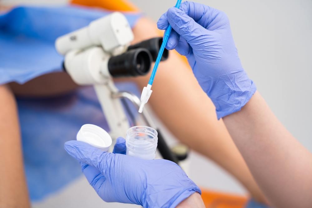 Perbedaan Pap Smear dan HPV DNA, Mana yang Lebih Efektif?