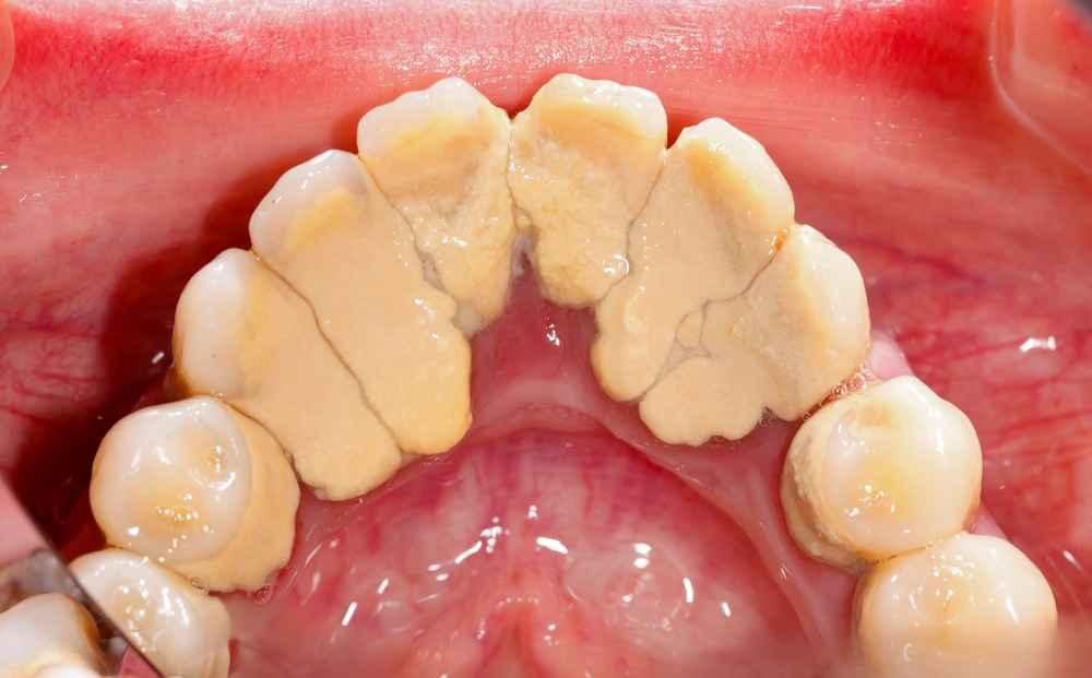 Apakah Karang Gigi Berbahaya? Ini Risikonya Jika Dibiarkan