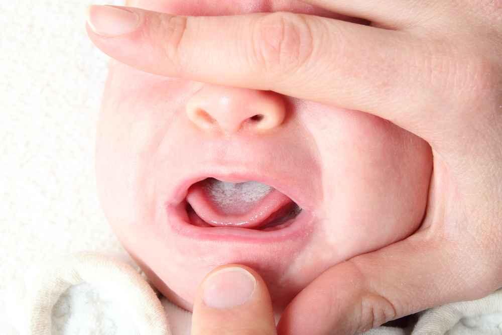 neonatal-candidiasis