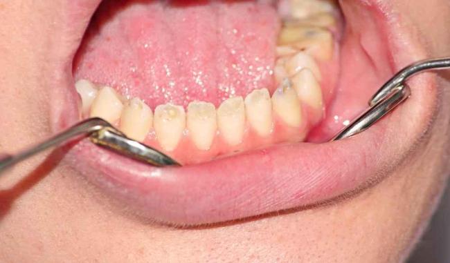 Hipoplasia Enamel