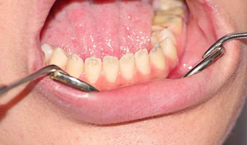 hipoplasia-enamel