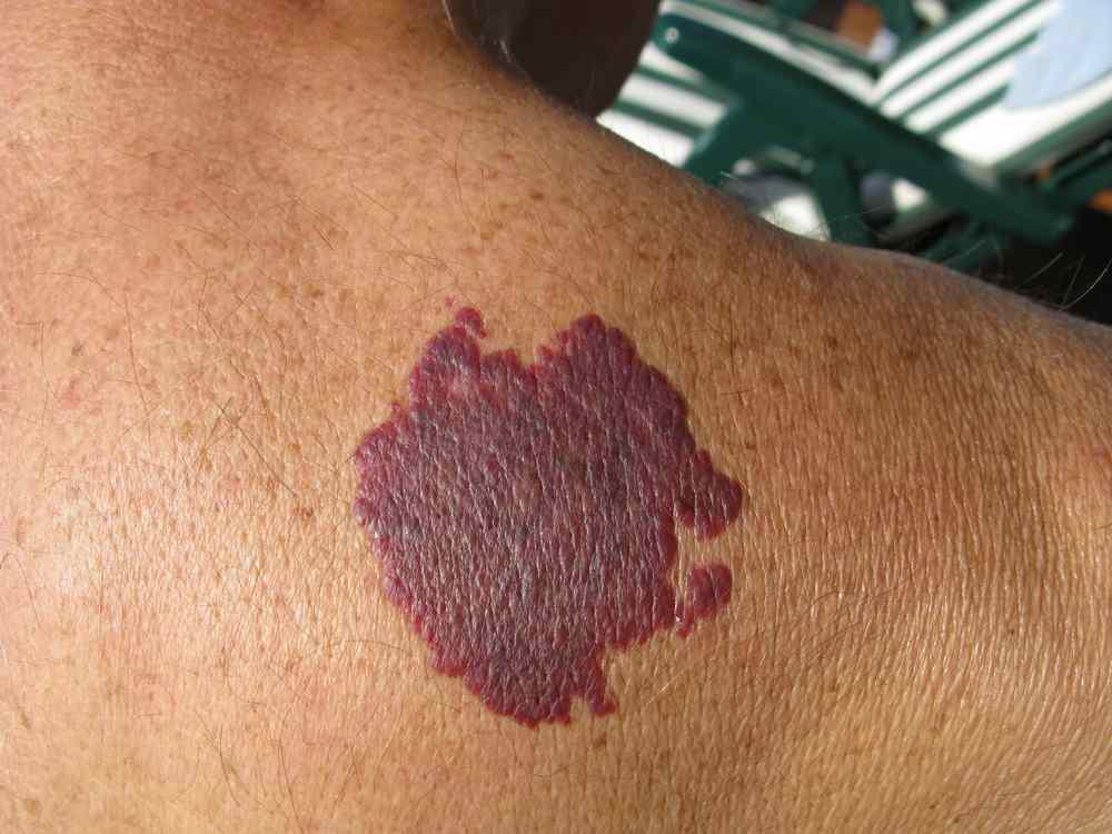 Port Wine Stain