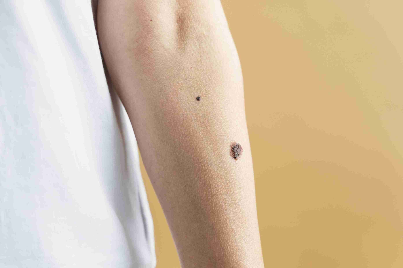 Ketahui 5 Penyebab Tahi Lalat Muncul secara Tiba-Tiba