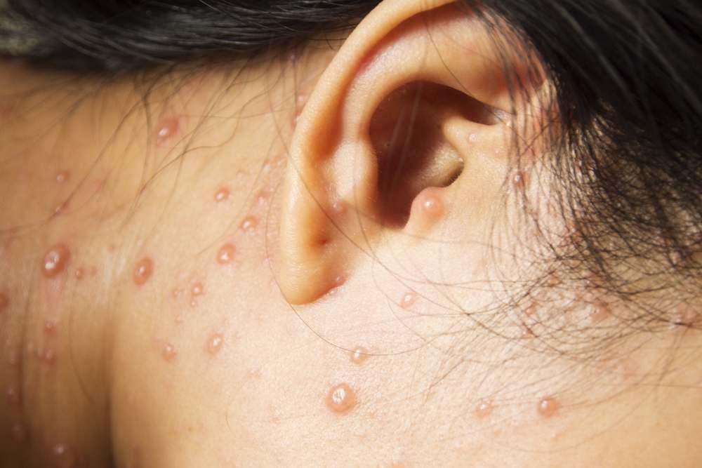 perbedaan-cacar-air-flu-singapura
