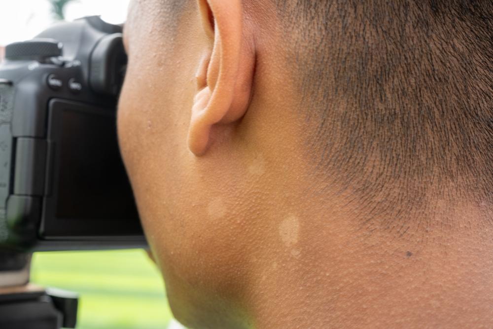 cara-menghilangkan-panu