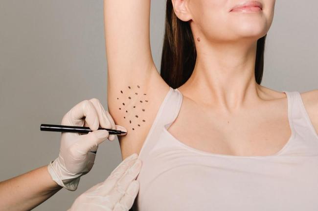 Hiperhidrosis Bisa Ditangani Permanen, Kenali Advanced Sweat Reduction