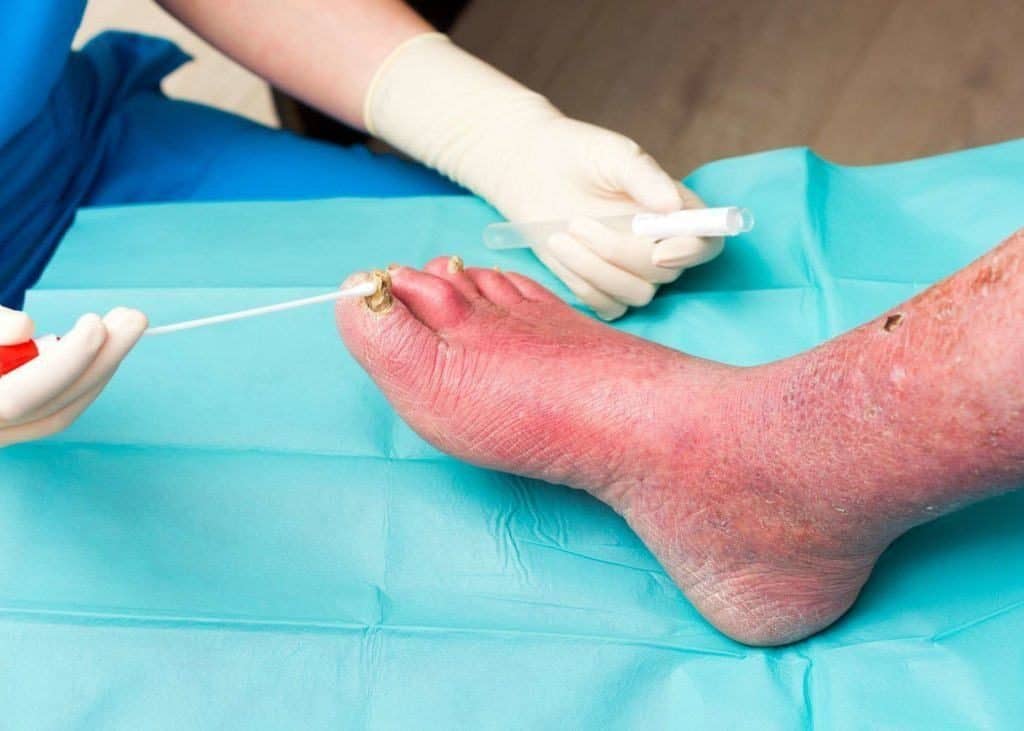 Diabetes Complications on Your Feet