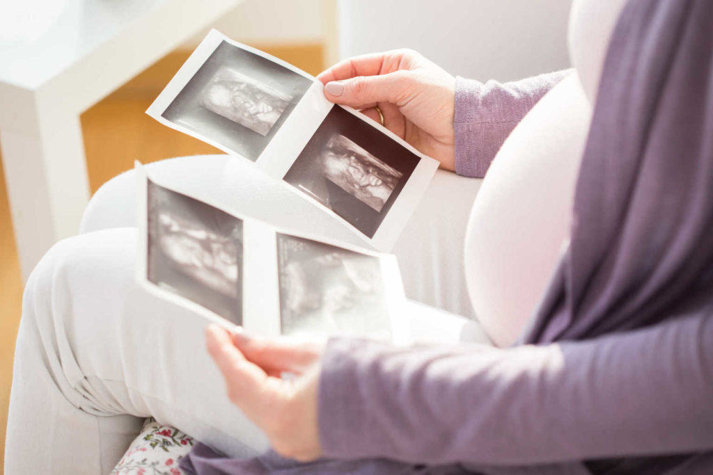 komplikasi kehamilan kembar