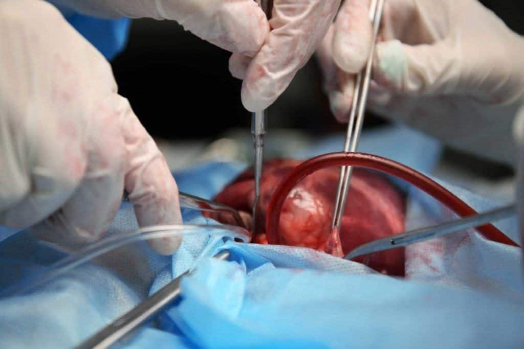 Mengenal Seluk Beluk Transplantasi Jantung